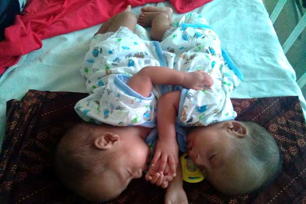 TIDUR: Bayi kembar siam dempet perut tampak tertidur di ruangan NICU RSUP H Adam Malik Medan. Keduanya tengah dilakukan perawatan intensif.