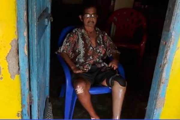 KUSTA: Seorang wanita penderita kusta di Canang, Belawan, saat ini butuh perhatian Pemko Medan.